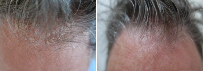 セルブースターヘア注射3回 左:施術前 / 右:施術後