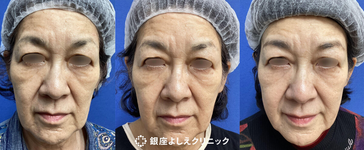 CPC-PRP（高濃度プレミアムPRP） 2回 施術前 / 施術後1ヶ月 / 2回目施術後1ヶ月