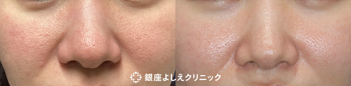 CPC-PRP（高濃度プレミアムPRP） 施術前 / 施術後