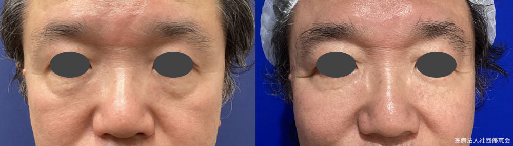 下眼瞼たるみ除去（経皮ハムラ法） 施術前 / 3ヶ月後