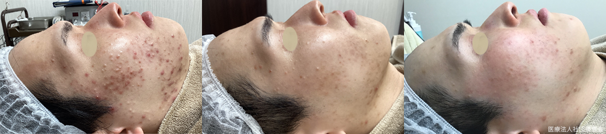 ジェネシス15回　ピーリング13回　30代男性 施術前 / 10回施術後 / 15回施術後