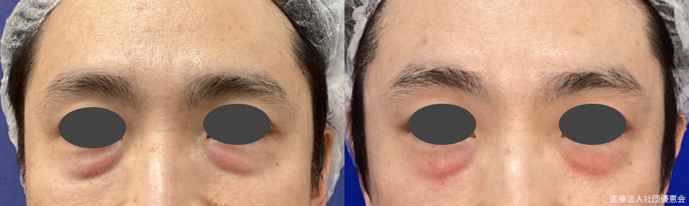 モフィウス　下眼瞼のたるみ（目の下のたるみ・クマ）　2回 施術前 / 2回目 1カ月後