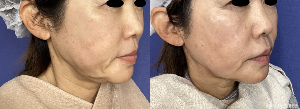 モフィウス8　5回　50代女性 施術前 / 5回施術後