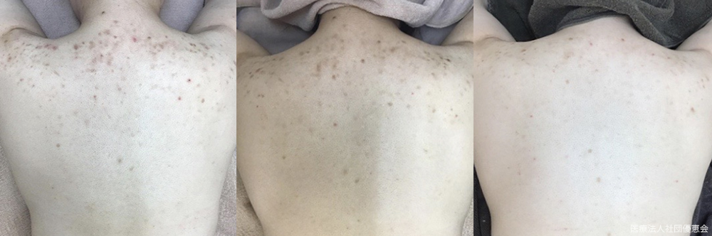 背中パーフェクトコース 施術前 / 5回目 / 10回目