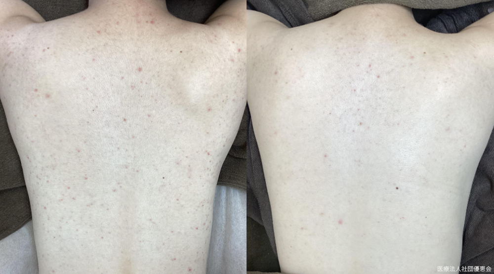 背中上下パーフェクトW（ブルージェネシス） 施術前 / 10回施術後