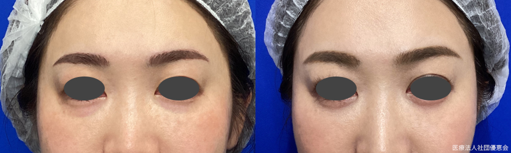 下眼瞼たるみ除去（裏ハムラ法／経結膜的眼窩脂肪移動術） 施術前 / 2ヶ月後