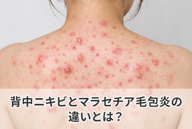 背中ニキビとマラセチア毛包炎の違いとは?治らない原因とニキビ跡が残る理由を解説