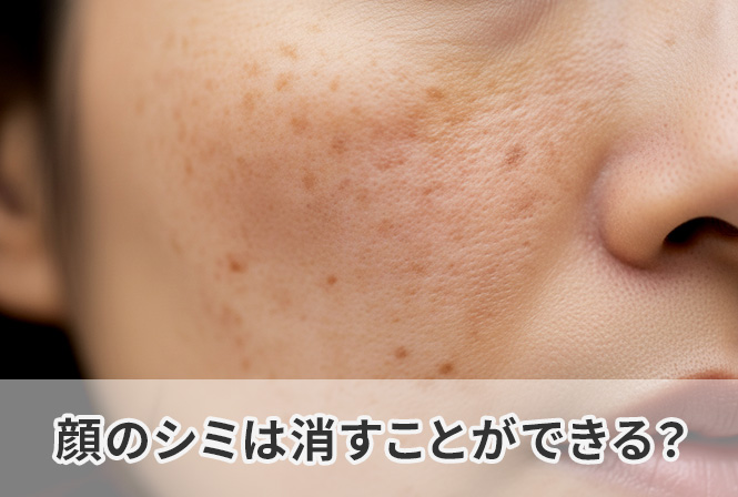 顔のシミは消すことができる? 保険診療と自費診療の治療の違いもご紹介