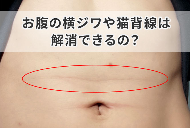 気になるお腹の横ジワや猫背線は解消できるの?
