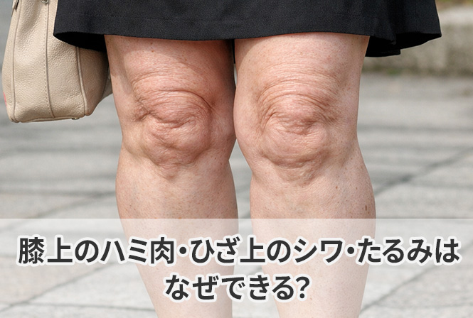 膝上のハミ肉・ひざ上のシワ・たるみはなぜできる？原因と改善方法を解説