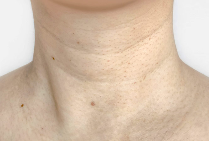 首のシワで10歳老けて見える理由!?首のシワをなくす方法とは