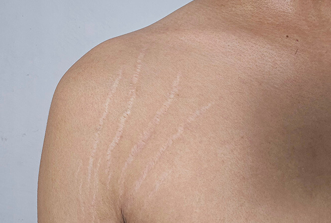 肉割れを消す方法・治し方「肉割れ(ストレッチマーク)」の原因とは