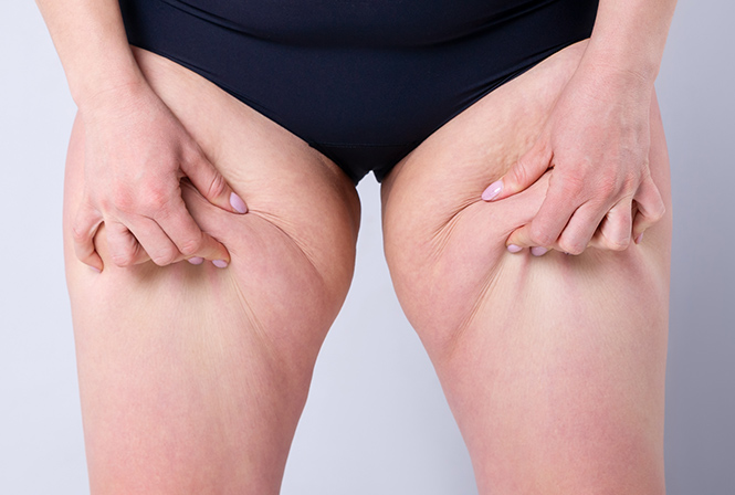 脚だけ痩せない理由とは。太ももが太くなる原因と太もも痩せする方法