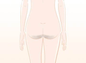 お尻の黒ずみの原因