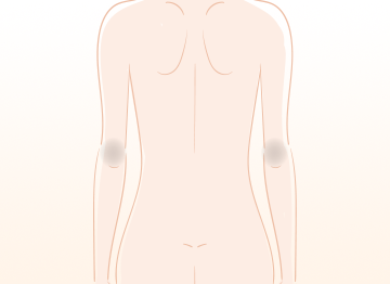 ひじの黒ずみの原因