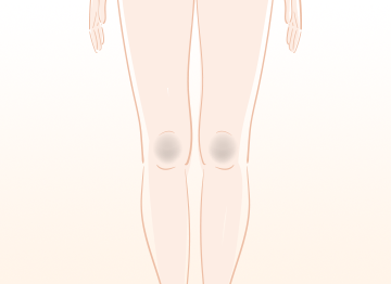 ひざの黒ずみの原因