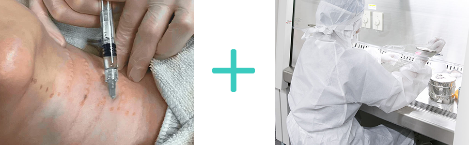 プルリアル デンシファイ×CPC-PRP®のコンビネーション治療