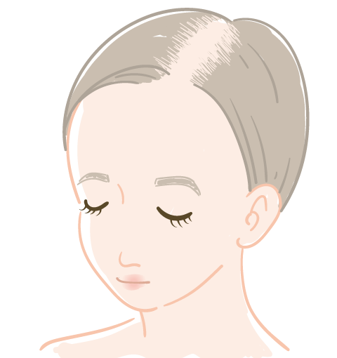 FAGA（女性男性型脱毛症）