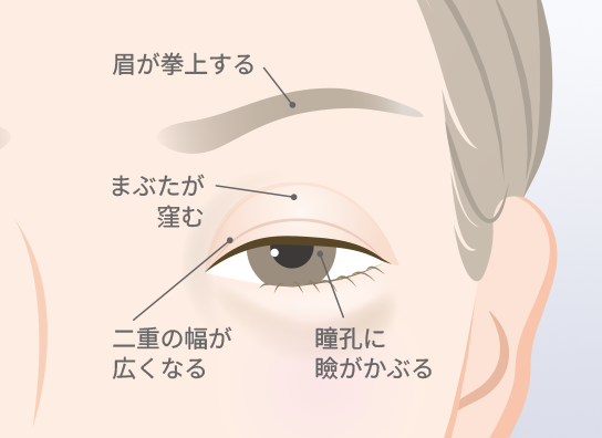 眼瞼下垂
