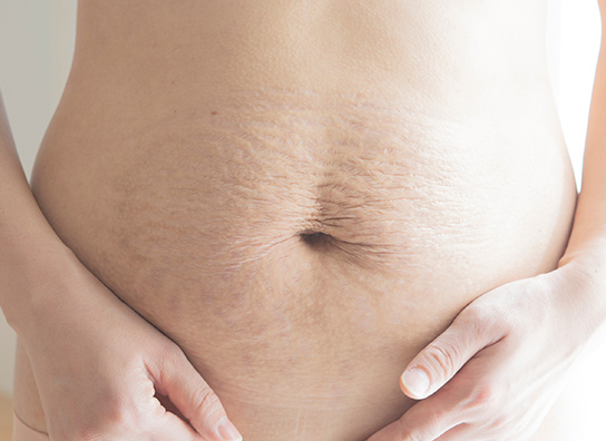 肉割れ（ストレッチマーク）・妊娠線の治療