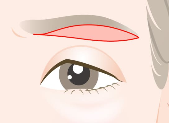 眉下リフト