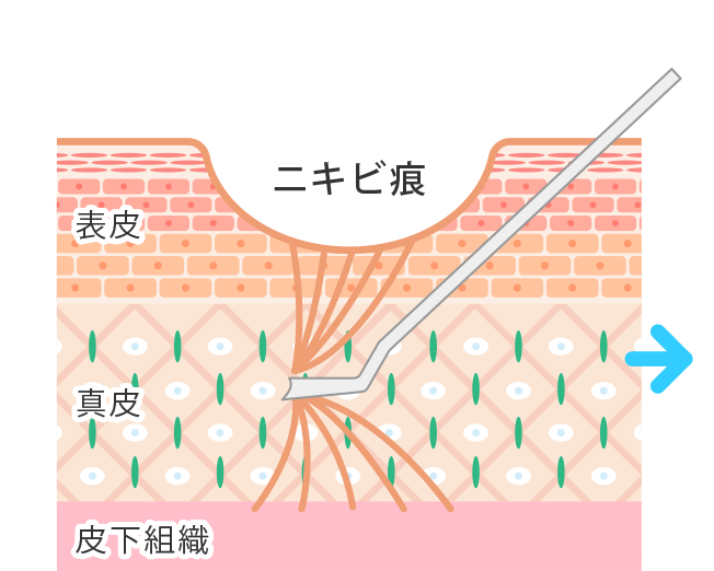 専用の針で癒着した組織を切り離す