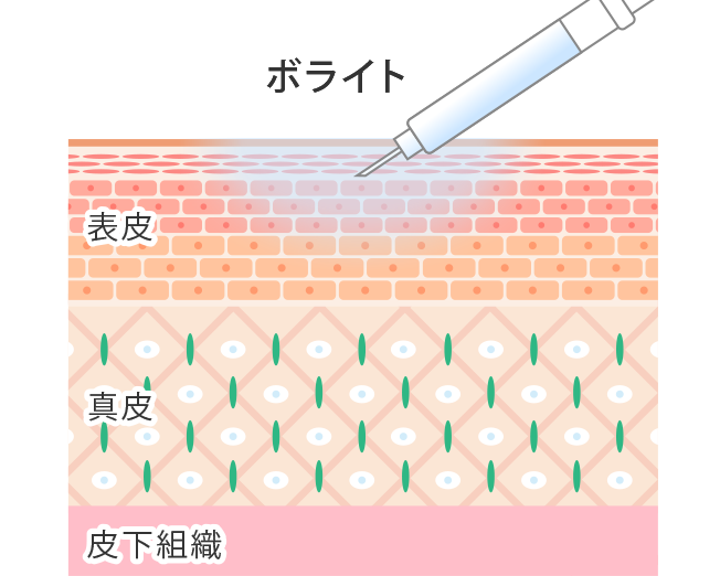 ボライト（ヒアルロン酸）を注入することで再癒着を防止してクレーターを改善