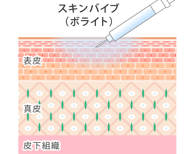 スキンバイブ（ヒアルロン酸／ボライト）を注入することで再癒着を防止してクレーターを改善