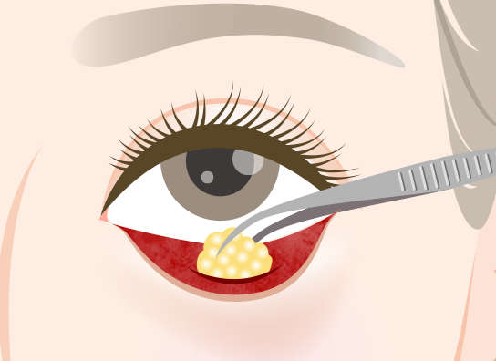 経結膜脱脂法